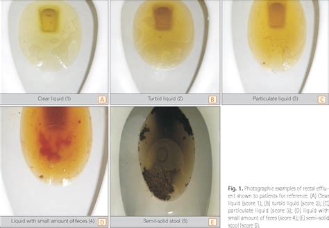 7 As the PA-PSRS report describes, syncope may occur. . Mucus in stool during colonoscopy prep